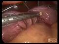 Laparoscopic Sleeve Gastrectomy