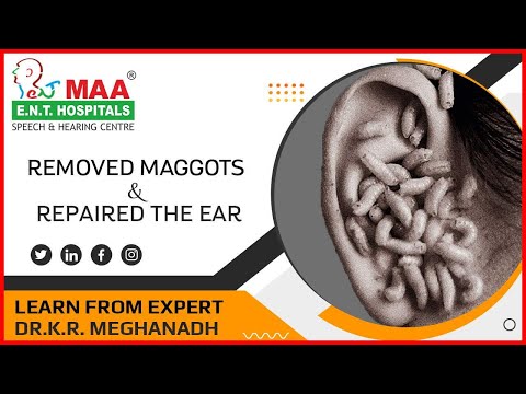 Successfully removed the maggots and repaired the ear By|| Dr.K.R.MEGHANADH