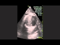 Aneurysm Of The Ventral Aorta Aneurysm Of The Ventral Aorta