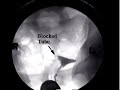 This HSG shows a blockage in the right fallopian tube