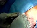 OR-Live.com webcast February 28th at 6:30 PM EST from Halifax Health Medical CenterHalifax Health will present Florida's first live online Automated Implantable Cardiac Defibrillator case on Thursday, February 28, at 6:30 pm.A majority of the 200,000 -- 400,000 people that die suddenly in the United States each year do so as a result of heart rhythm abnormalities known as ventricular tachycardia and ventricular fibrillation. An implantable cardioverter-defibrillator (ICD) is a battery-powered device that significantly improves the chances of survival in people at high risk for these arrhythmias. Modern ICDs are sophisticated devices that are able to perform three general functions: treatment of dangerous ventricular arrhythmias, record the heart's activity in the device memory, and standard pacemaker functions.Hanscy Seide, MD, will perform the procedure and Donald Stoner, MD, Chief Medical Officer at Halifax Health Medical Center, will moderate. Dr. Seide, who is with Cardiology Consultants in Daytona Beach, has implanted more than 350 defibrillators during the past three years.
