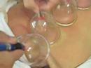 Hei getting some cupping  Alternative Medicine Cupping