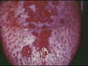 gonorrhea-reference