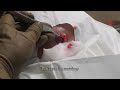 Pilar Cyst Excision Las Vegas Dermatology.m4v