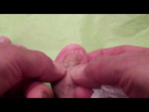 toenail