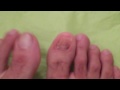 Watch 'TOENAIL FUNGUS DOCUMENTARY DAY 24'