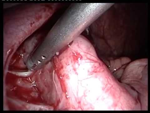 how to drain appendix abscess