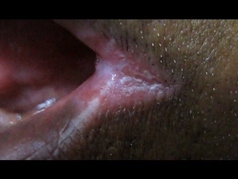 how to cure angular cheilitis