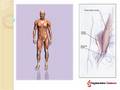 The Regenexx procedure to treat Hip Bursitis