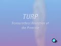 PreOp®  Patient Education: TURP Prostate Surgery