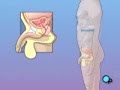 PreOp® Patient Education: TURP Prostate Surgery