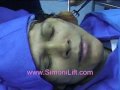 Simoni Lift, The Face lift of the Future, Actual procedure Simoni Lift, The Face lift of the Future, Actual procedure