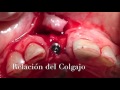 Implante sector anterior