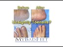 toenail Treatment, Dr. Smith\