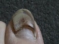 Death of Toe Nail