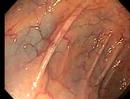 Normal colonoscopy