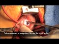 Tetralogy of Fallot Repair, TOF