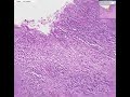 Histopathology Stomach--Adenocarcinoma