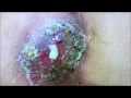 Large Carbuncle Back with Pus Discharge