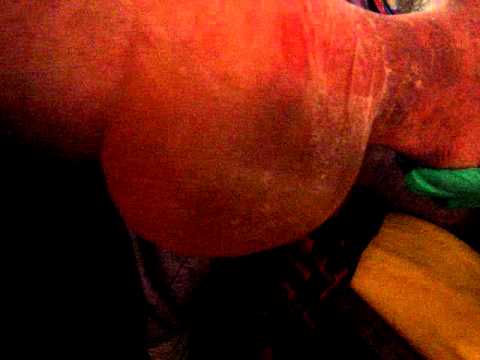 how to drain edema fluid