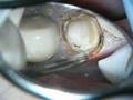Crown Troughing with PerioLase MVP7
