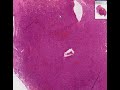 Histopathology Lymph node--Lymphoblastic lymphoma - lymphobl