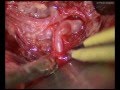 MCA aneurysm - Right pterional approach