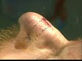 Nasal Valve Reconstruction With a Monarch Implant, Video 1