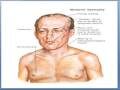 Myotonic dystrophy
