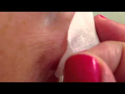 how to remove nose blackheads