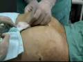 Brazilian Butt lift Buttock lift by Serdev suture No incisions No downtime serdev@gmail.com