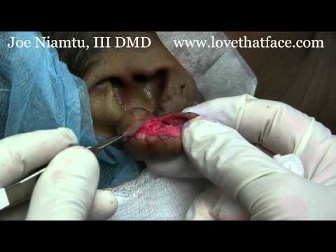 how to remove keloids