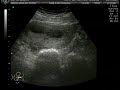 Ximena o Mariano a las 11 Semanas de Gestacion Ximena o Mariano a las 11 Semanas de Gestacion