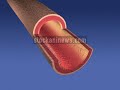 Bill Clinton hospitalized gets stents. This animation on the STENT procedure is available on request at : www.stockani.com