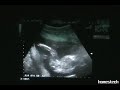 Echographie a 20 semaines