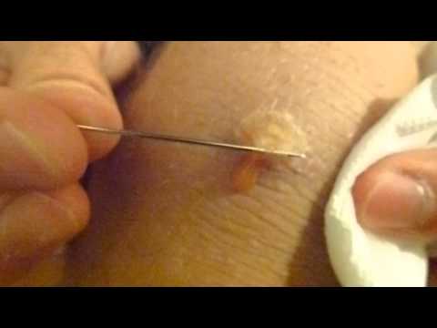 how to drain a zit with a needle