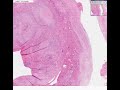 Histopathology Stomach--Adenocarcinoma (linitis plastica) Histopathology Stomach--Adenocarcinoma (linitis plastica)