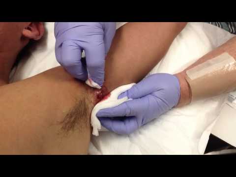 how to drain armpit cyst