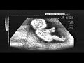 Michael Schumacher in the Womb