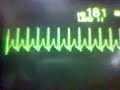 ECG Video: Paroxysmal supraventricular tachycardia