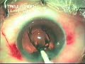 Foldable IOL insertion Dr. Sudhalkar