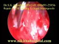 CSF Leak Surgery Nasal Endoscopy NikithaHospital CSF Leak Surgery Nasal Endoscopy NikithaHospital