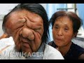 Lymphatic Filariasis (AKA Elephantitis)