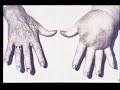 Lymphatic Filariasis (AKA Elephantitis)