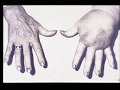 Lymphatic Filariasis (AKA Elephantitis)