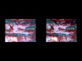 Mini-open removal of intradural spinal tumor (3D)