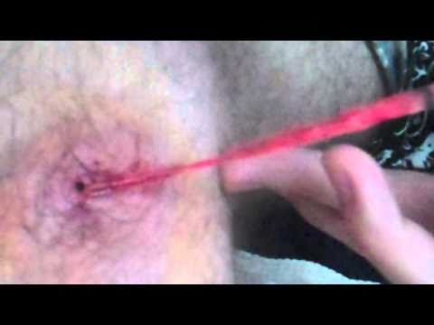 THE GROSSEST LEG INFECTION EVER!!!
