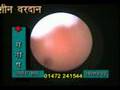 HINDI HYSTEROSCOPY