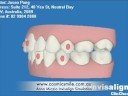 Cosmetic Invisalign Dentist|Neutral Bay, Sydney Cosmetic Invisalign Dentist|Neutral Bay, Sydney