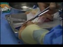 Anterior Vaginal Repair Anchored Proximally